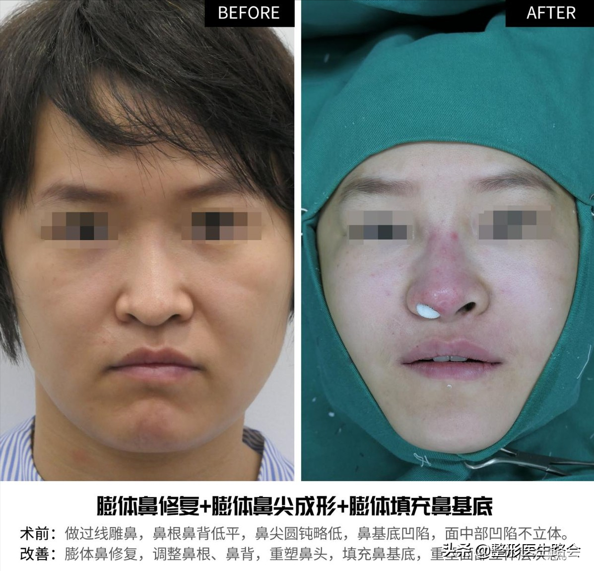 做鼻整形我只有两点要求:必须创伤小，必须能蹦极 图片-9