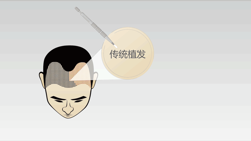 植发小白进