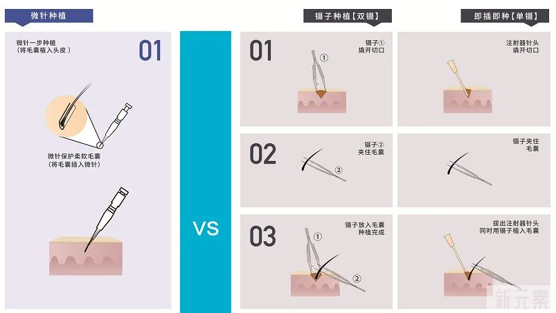 植发小白进