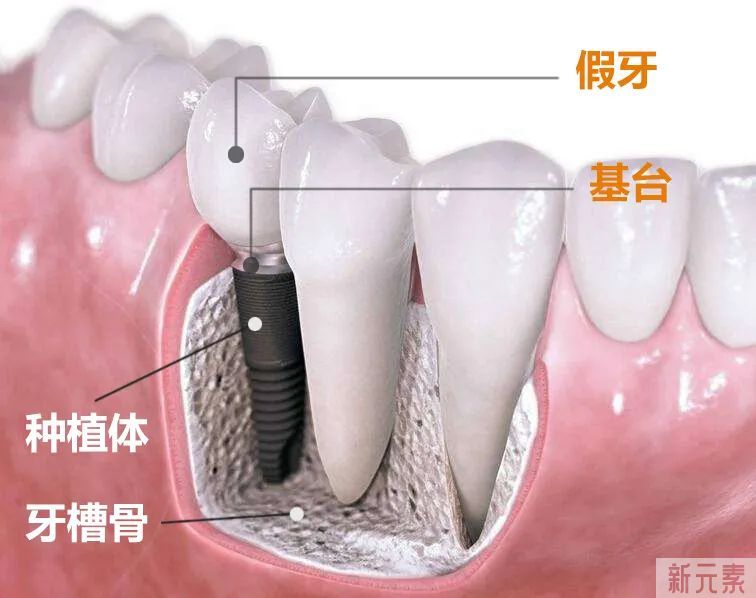 种植牙可怕吗?医生:比拔智齿还轻松! 图片-2