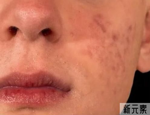 痘印应该怎么办? 图片-1