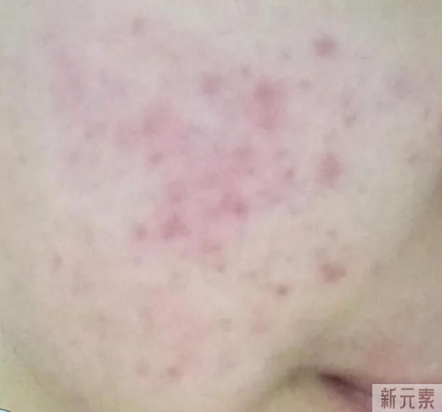 痘印应该怎么办? 图片-2