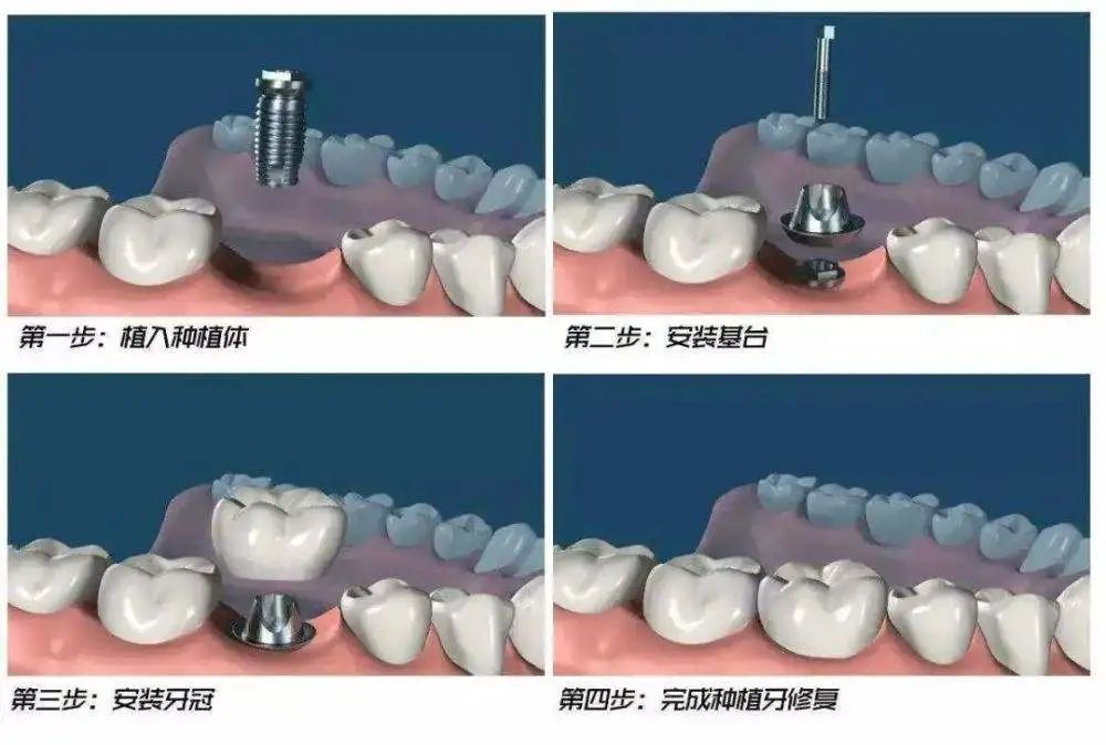 种牙需要多少钱，种牙医院怎么选，你心里有底吗? 图片-4