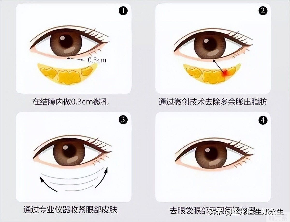 妈妈的眼袋和你的眼袋有什么不同，去眼袋方法能选择一样的吗? 图片-4
