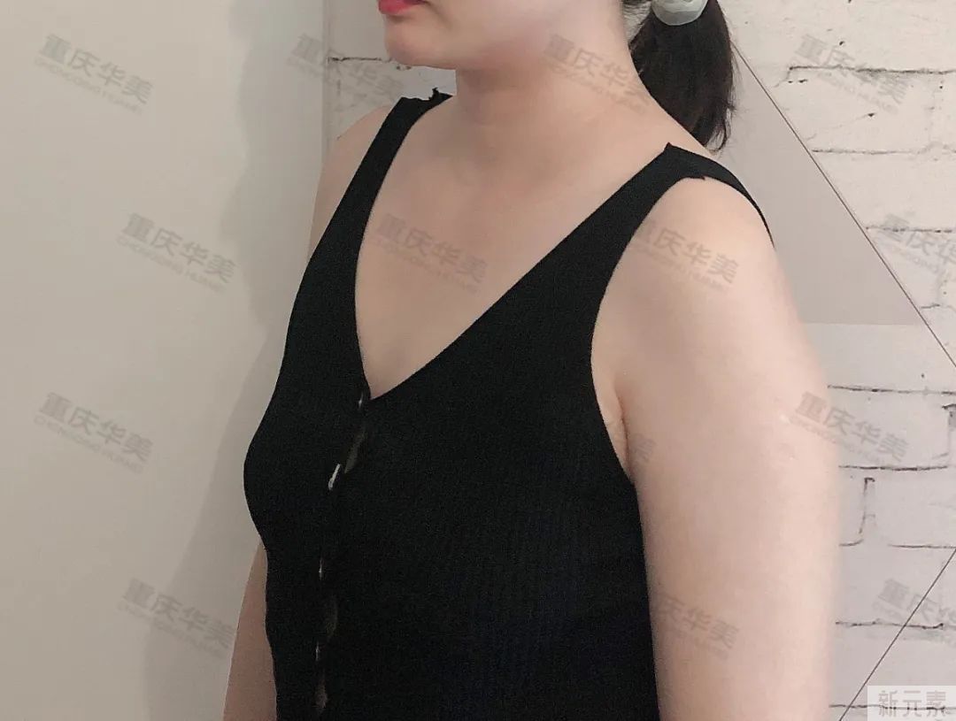 隆胸后，你的生活有变满意吗?我们采访了50+女性 图片-11