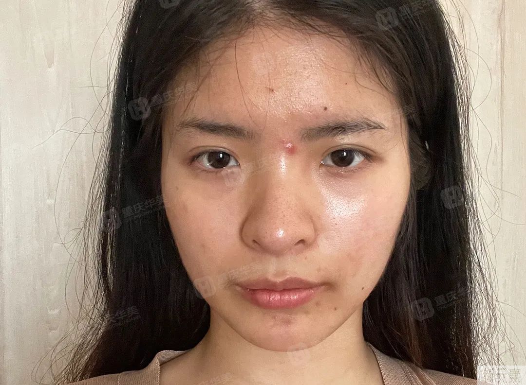 100元和1000元的光子嫩肤，到底有什么区别? 图片-8