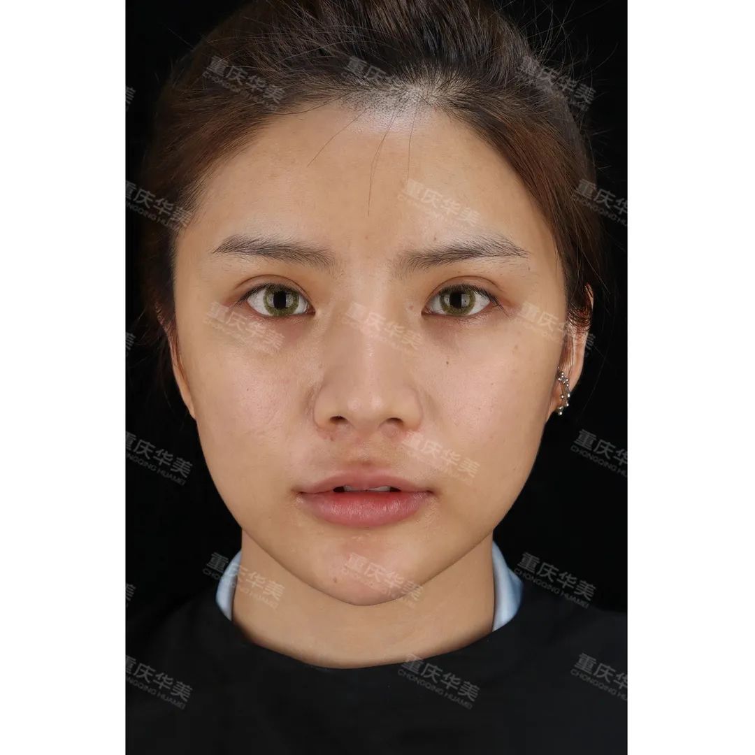 100元和1000元的光子嫩肤，到底有什么区别? 图片-14