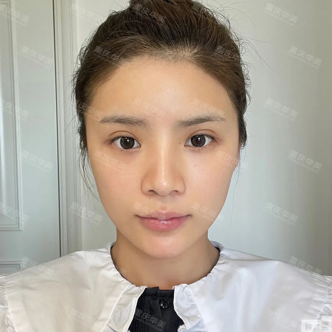 100元和1000元的光子嫩肤，到底有什么区别? 图片-13