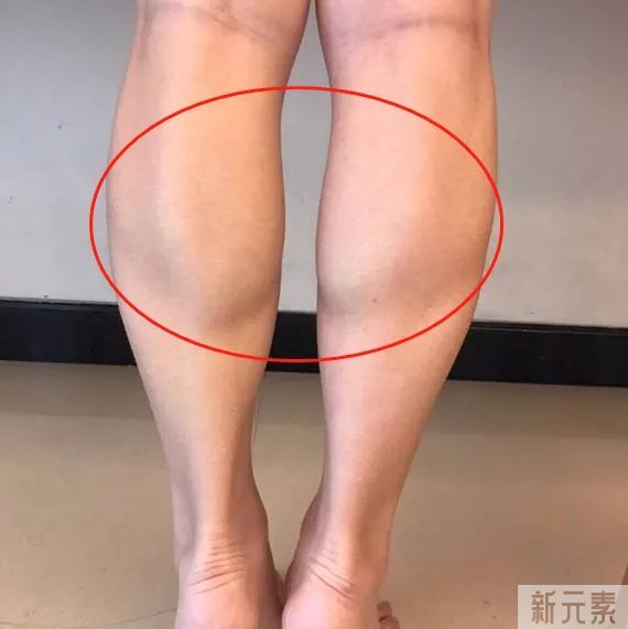 关于瘦腿，注射瘦腿vs吸脂，哪个效果更好? 图片-5