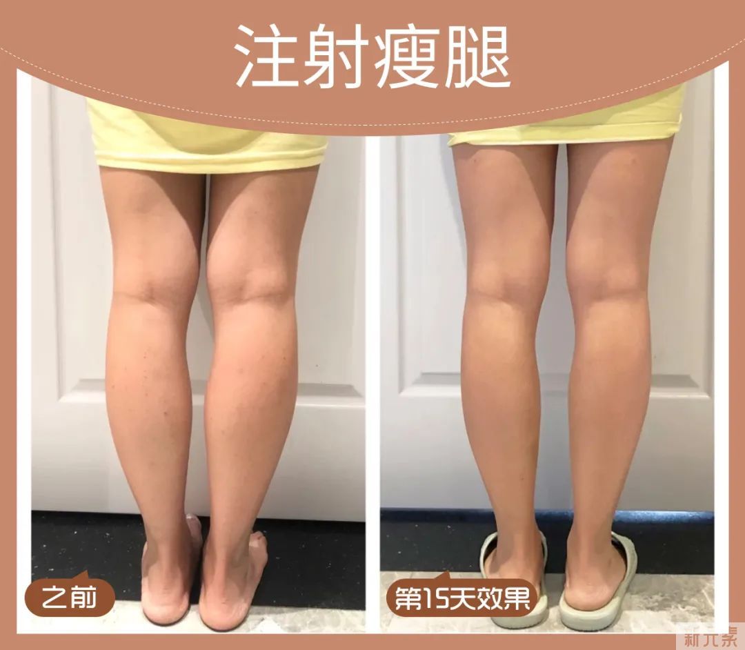 关于瘦腿，注射瘦腿vs吸脂，哪个效果更好? 图片-7