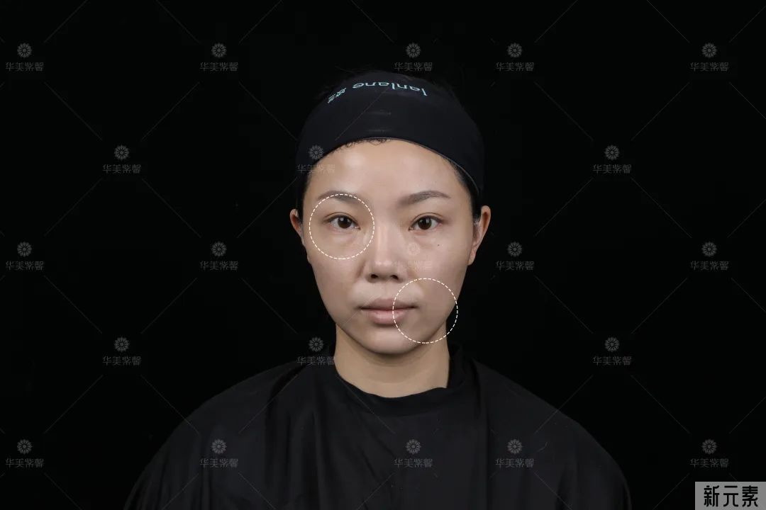 1条泪沟=老10岁，祛除泪沟你用对方法了吗? 图片-4