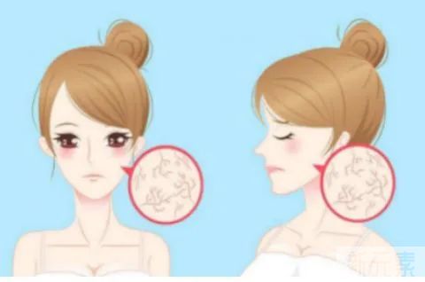 川字纹、抬头纹、鱼尾纹这么多皱纹，注射除皱后，脸会僵吗? 图片-6
