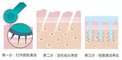 伊肤泉微针，让你皮肤回到少女时代 图片-11