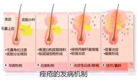 伊肤泉微针，让你皮肤回到少女时代 图片-10