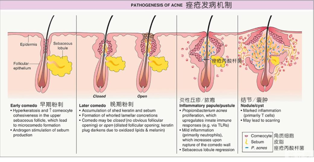 如此的抗痘成果，是怎么做到的? 图片-2