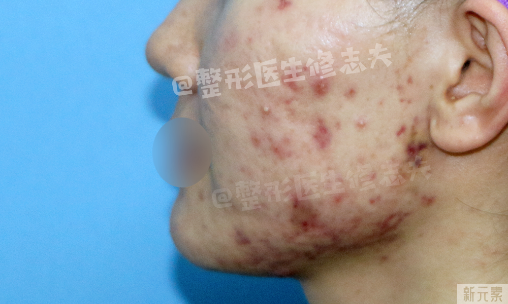 如此的抗痘成果，是怎么做到的? 图片-5