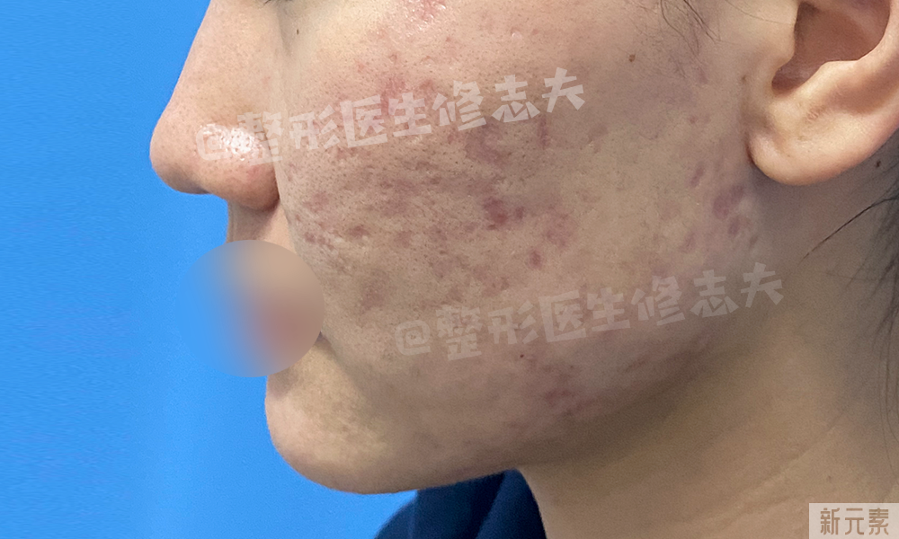 如此的抗痘成果，是怎么做到的? 图片-11