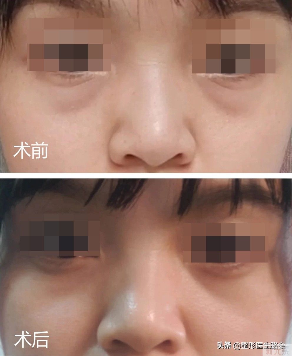 泪沟填充有6大常见方法(3)想知道哪种更适合你吗? 图片-3