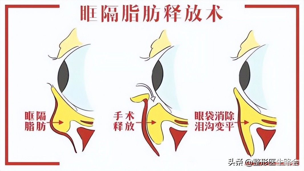 泪沟填充有6大常见方法(3)想知道哪种更适合你吗? 图片-1