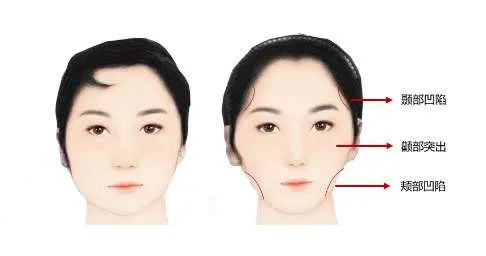 正畸过程中，你可能会遇到的3大问题! 图片-6