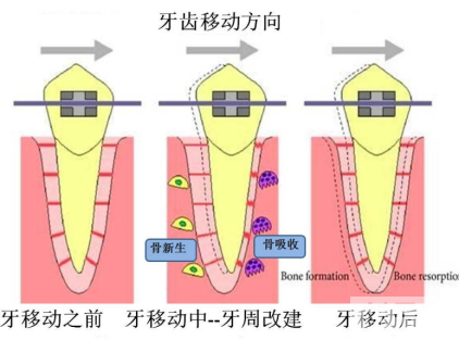 正畸过程中，你可能会遇到的3大问题! 图片-11