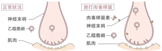 不了解这些真相，我劝你千万别注射肉毒素! 图片-2