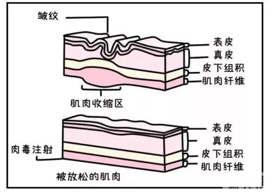不了解这些真相，我劝你千万别注射肉毒素! 图片-4