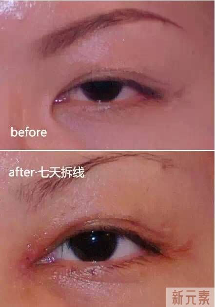如何判断自己是否需要开眼角?请对号入座~ 图片-11