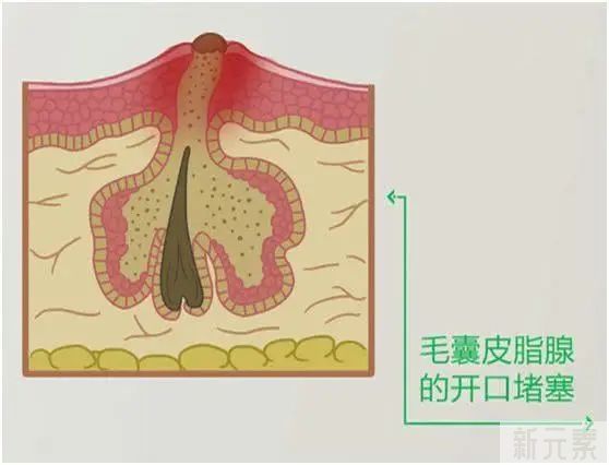 宅家为啥易冒痘?原来是这两件事没做好(附祛痘攻略) 图片-4