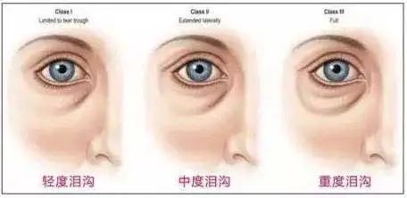 有了泪沟怎么办? 图片-3
