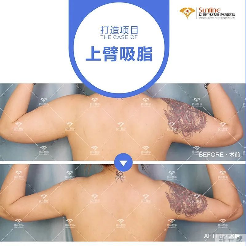 为什么大家扎堆在春天做整形?春季适合做哪些项目? 图片-9