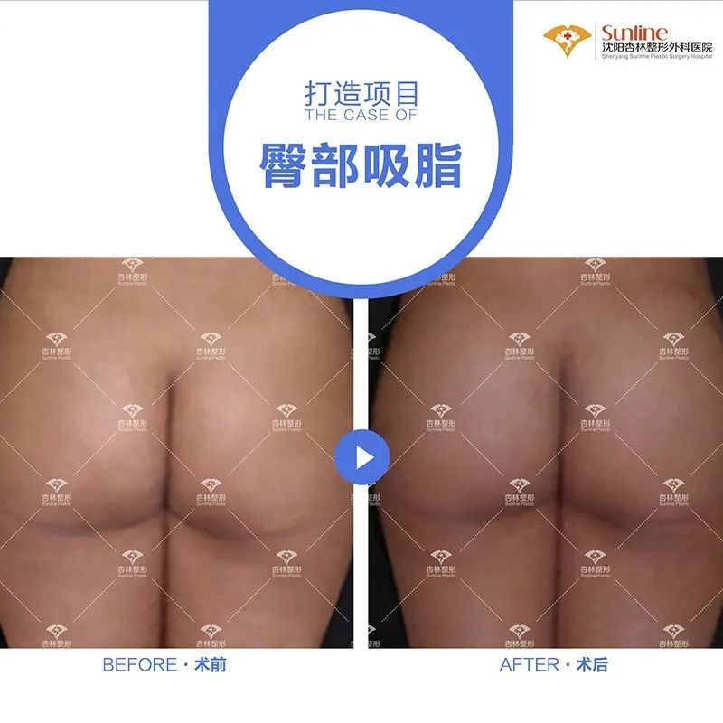 为什么大家扎堆在春天做整形?春季适合做哪些项目? 图片-8