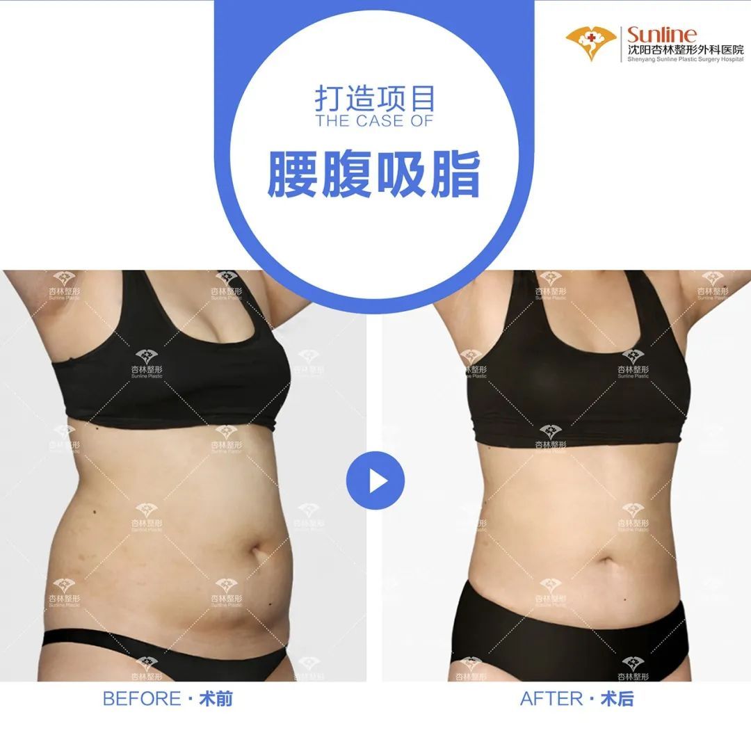 为什么大家扎堆在春天做整形?春季适合做哪些项目? 图片-7