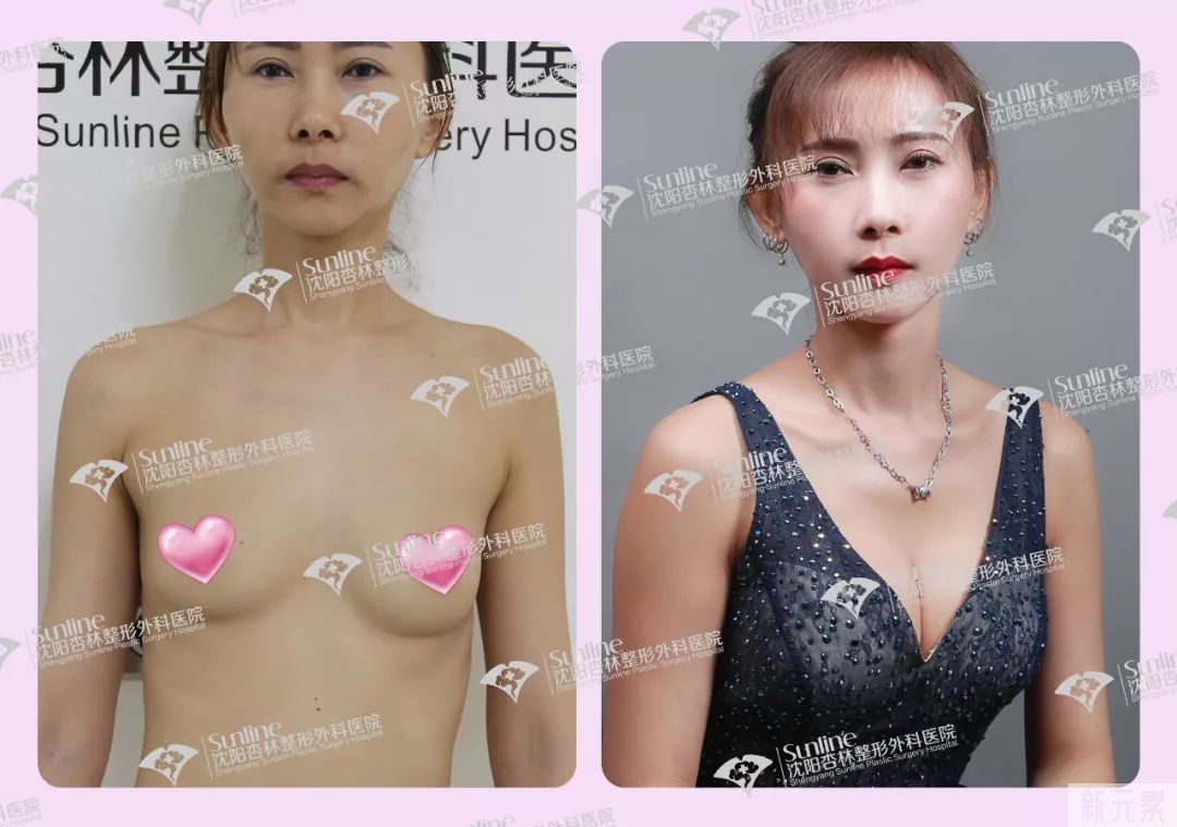 为什么大家扎堆在春天做整形?春季适合做哪些项目? 图片-13