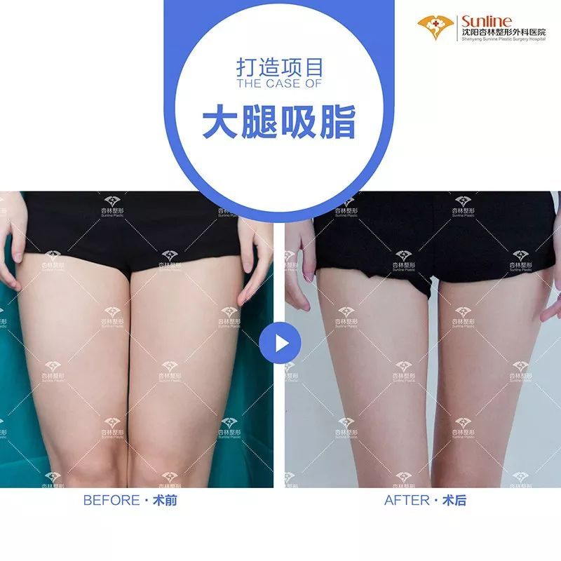 为什么大家扎堆在春天做整形?春季适合做哪些项目? 图片-10