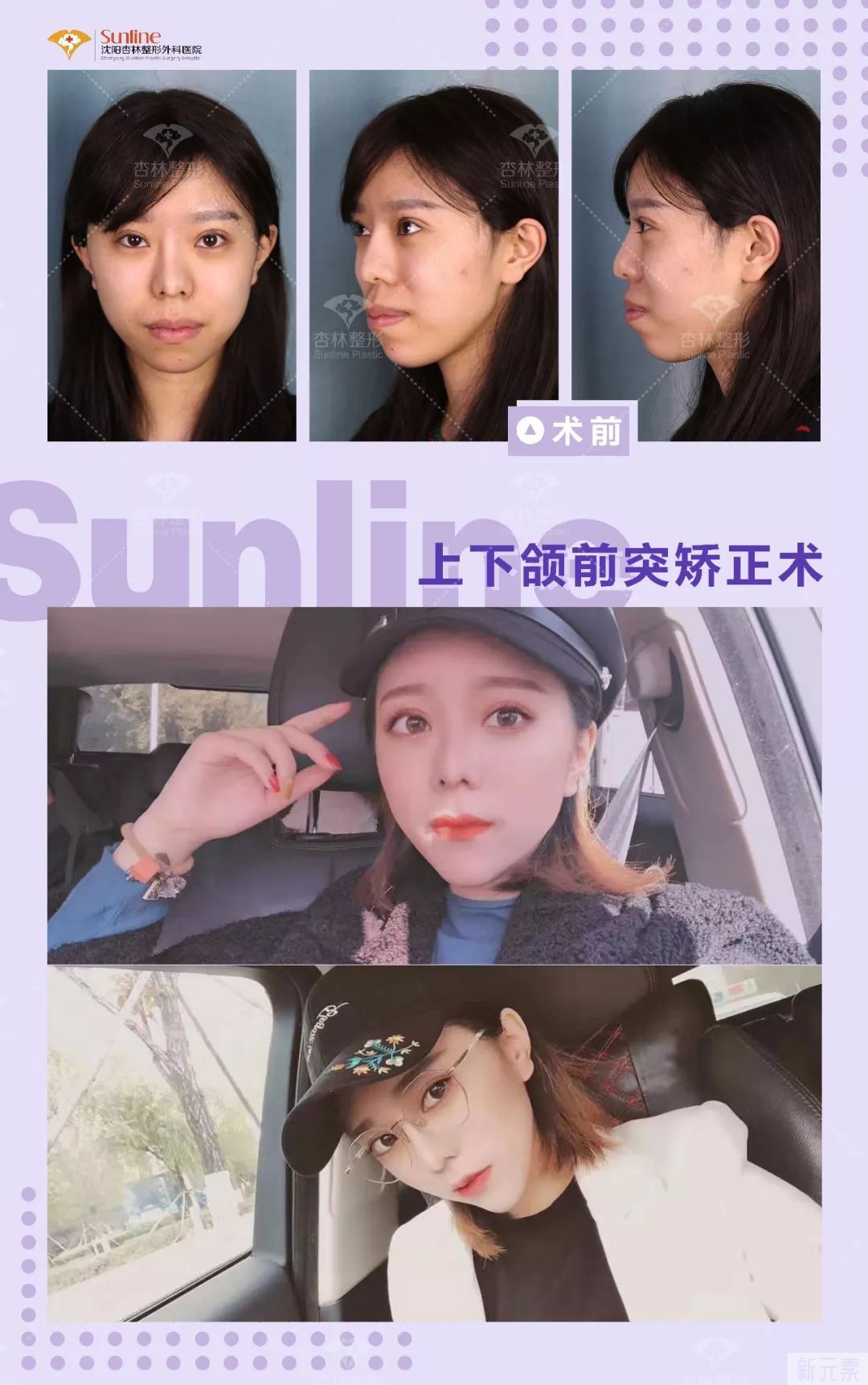 为什么大家扎堆在春天做整形?春季适合做哪些项目? 图片-18