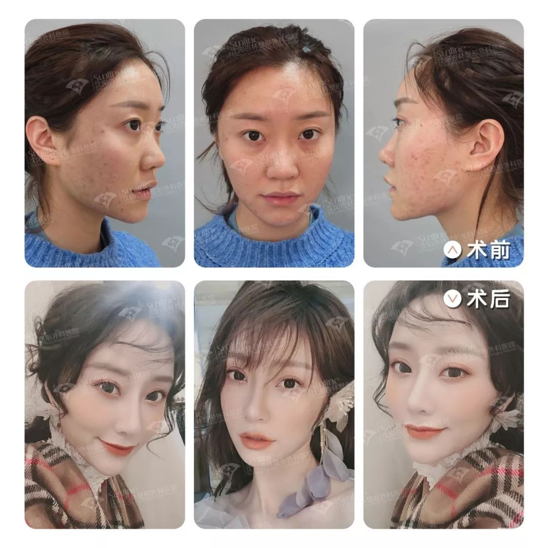 为什么大家扎堆在春天做整形?春季适合做哪些项目? 图片-28