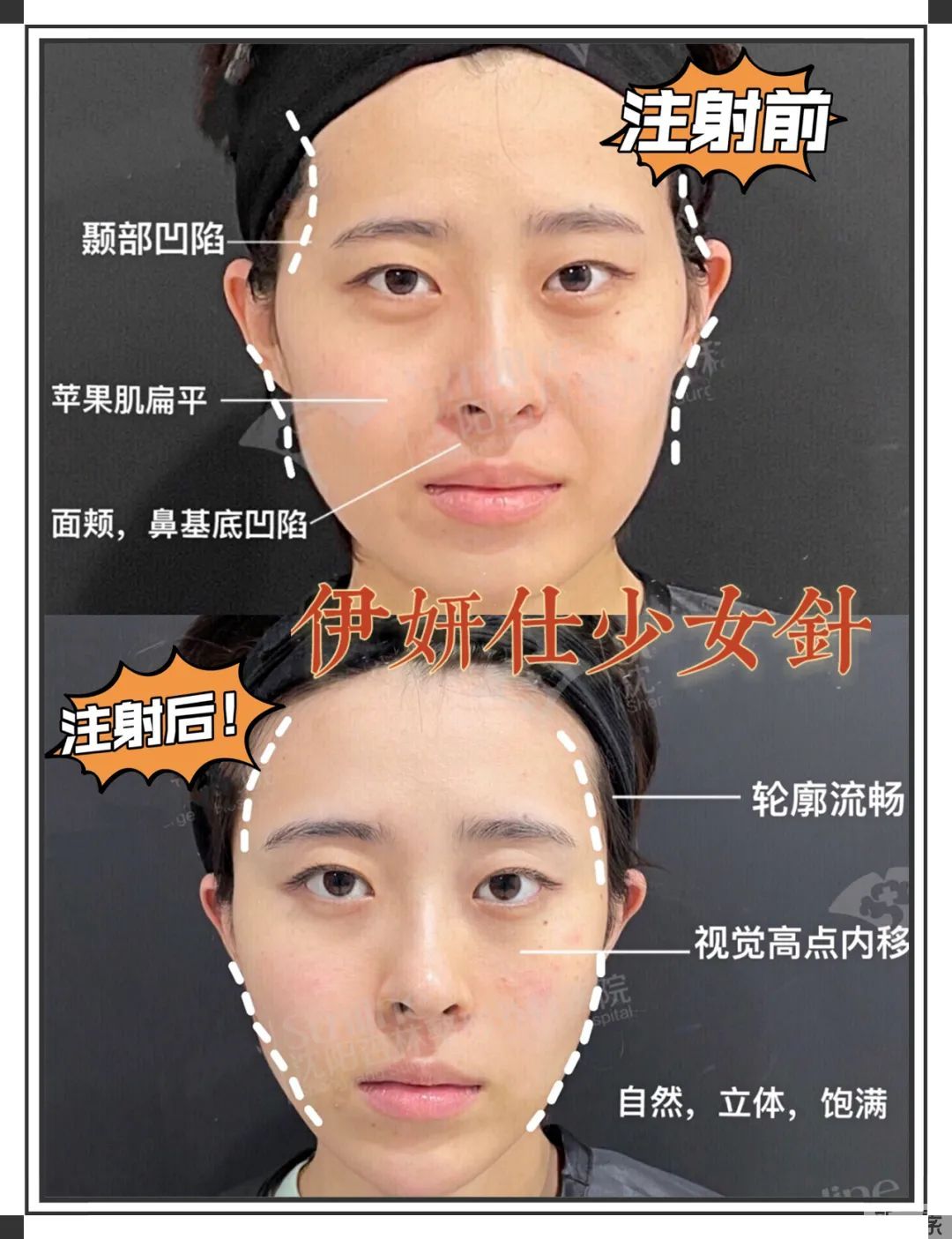 为什么大家扎堆在春天做整形?春季适合做哪些项目? 图片-32