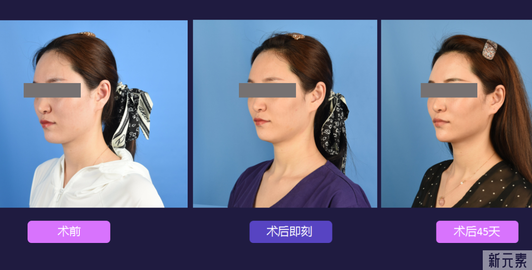 为什么大家扎堆在春天做整形?春季适合做哪些项目? 图片-35