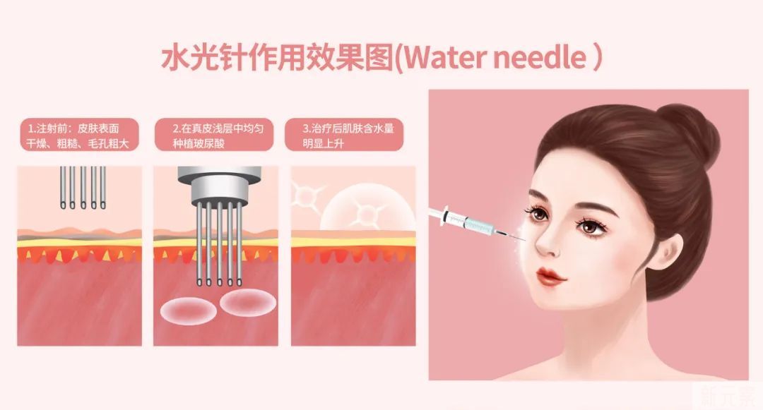 毛孔粗大的预防以及治疗 图片-6