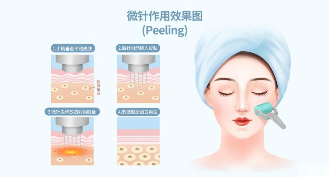 毛孔粗大的预防以及治疗 图片-8