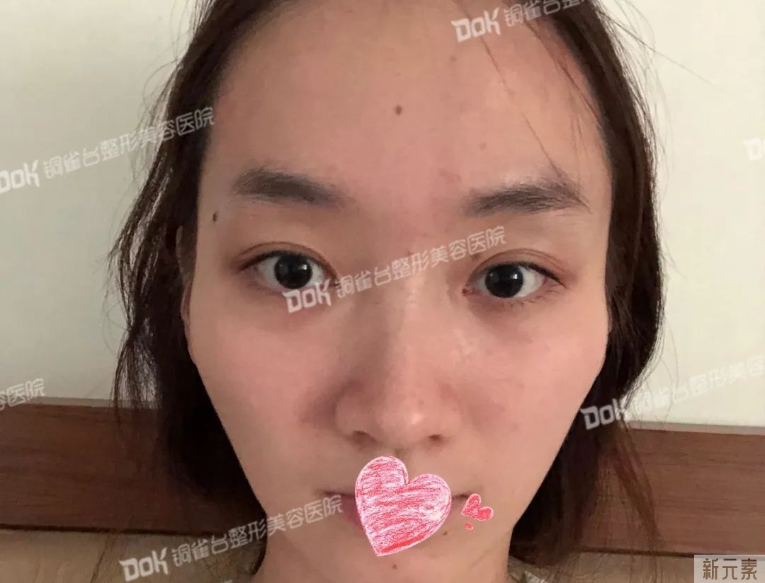 自体脂肪必看攻略 