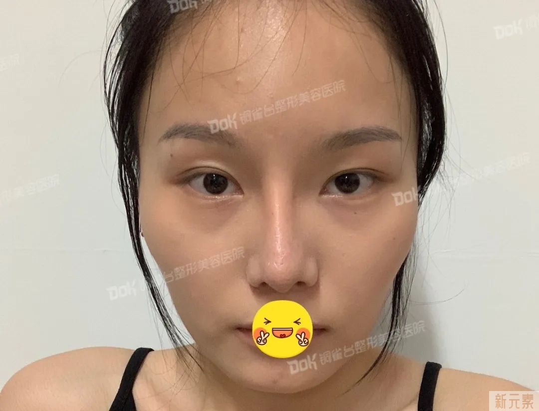 自体脂肪必看攻略 