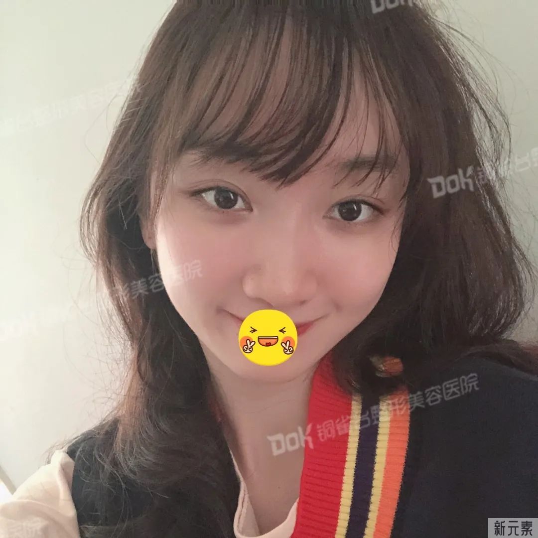 自体脂肪必看攻略 