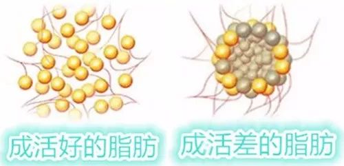 自体脂肪必看攻略 