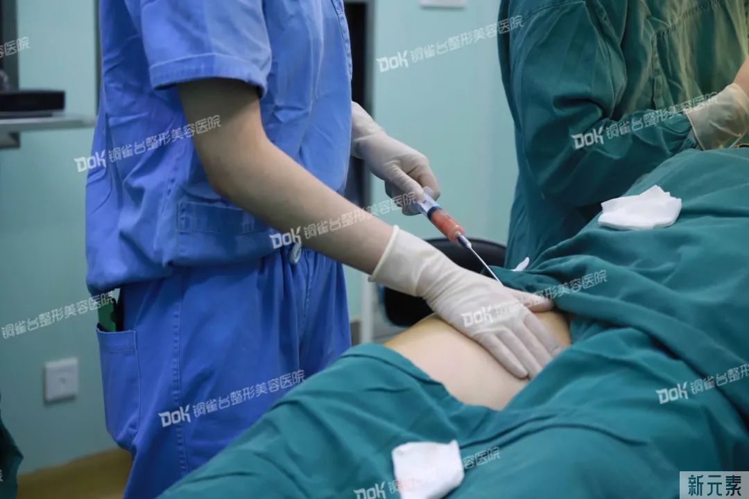 自体脂肪必看攻略 