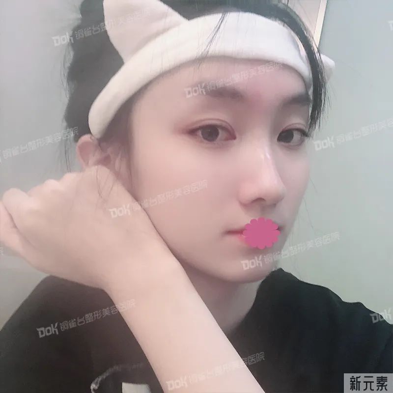 自体脂肪必看攻略 