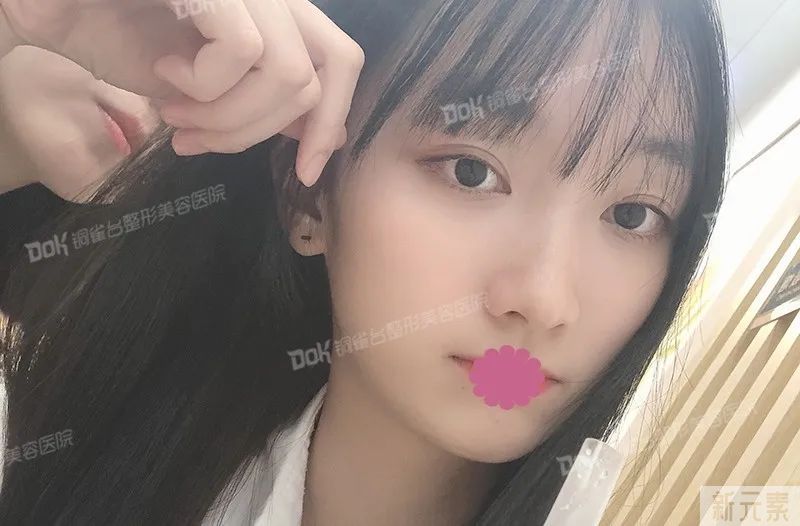 自体脂肪必看攻略 
