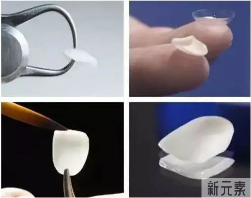 牙齿做瓷贴面会掉吗? 图片-8