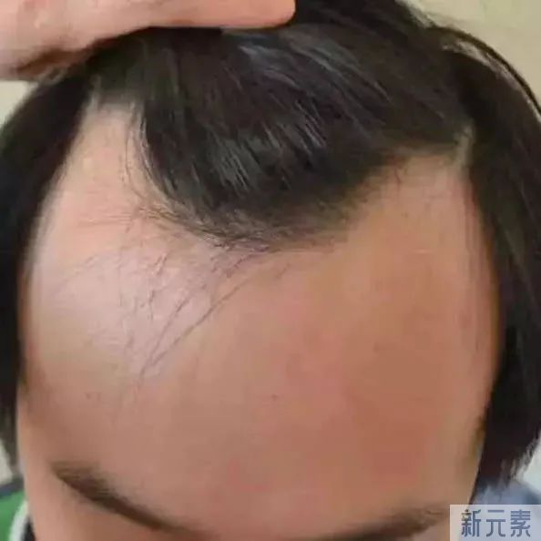 治雄激素性脱发的方法，一文辩真假 图片-2